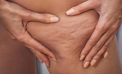 Cellulite endematosa